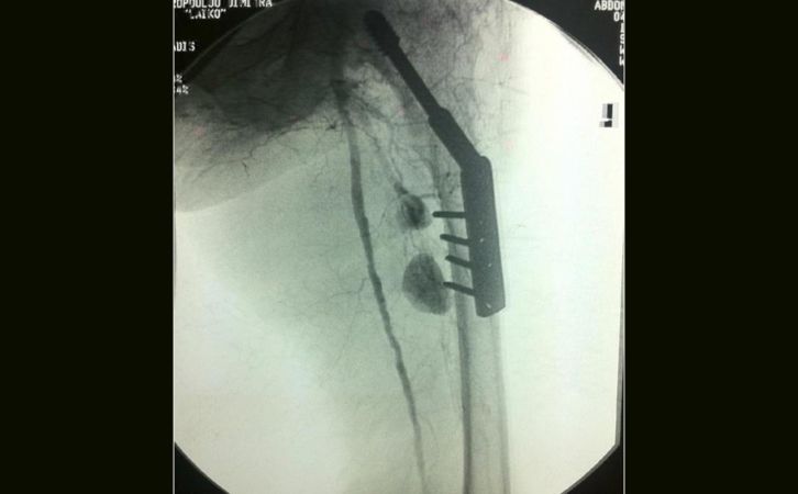 Iatrogenic injury of profunda femoris artery branches after intertrochanteric hip screw fixation for intertrochanteric femoral fracture: a case report and literature review