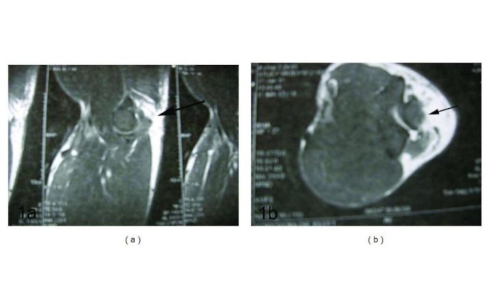 Synthetic augmented suture anchor reconstruction for a complete traumatic distal triceps tendon rupture in a male professional bodybuilder with postoperative biomechanical assessment