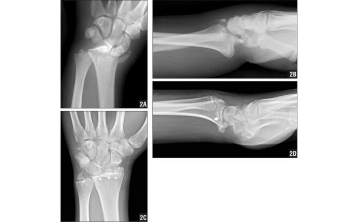 Radiocarpal dislocations: review of the literature with case presentations and a proposed treatment algorithm