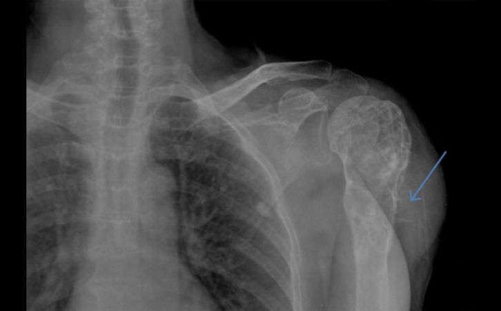 Treatment of proximal humeral chondrosarcoma with resection and allograft